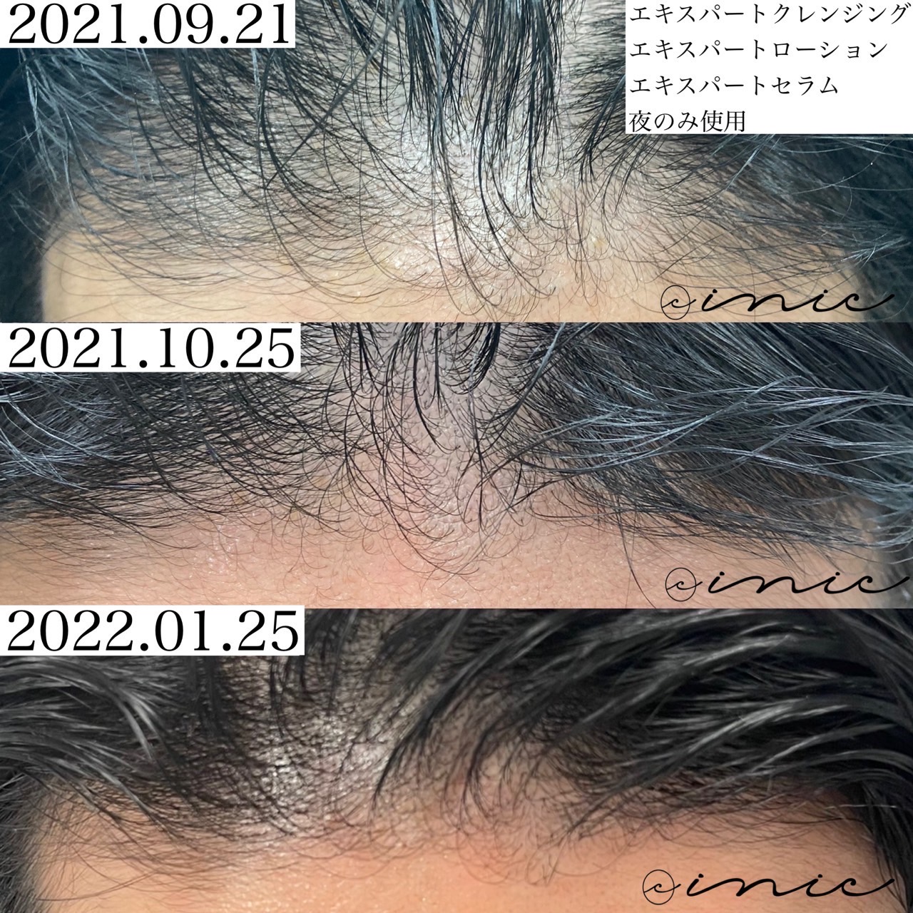 予約受付中】リアボーテ AC頭皮トリートメントとは？〈養毛×頭皮 